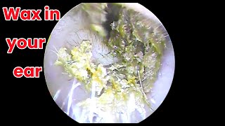 Ear picking  Cleaning earwax asmr ear cleaning wax in your ear Ear health ear piercing cleaning [upl. by Renita440]