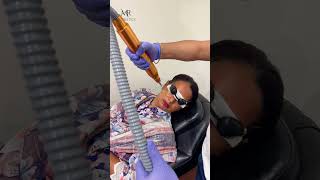 Pico Laser by Dr Rizwan Malik  MR Aesthetics Lahore  Dr Rizwan Malik  youtubeshorts trending [upl. by Igig217]