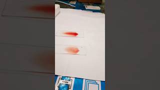 Making a peripheral blood smear  blood smear preparation  prepare a perfect blood smearHematology [upl. by Adianes]