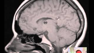 Cysticercosis multiple of Brain MRI DISCUSSION [upl. by Nnahoj557]