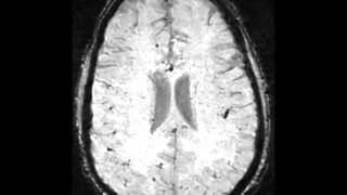 Cerebral Amyloid Angiopathy [upl. by Ahtinak326]