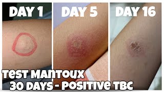 Before After 30 Days Test Mantoux  Positive Tuberculosis TBC [upl. by Namqul]