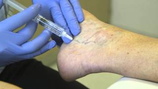 Spider Vein Treatment  Sclero Therapy [upl. by Nnod]