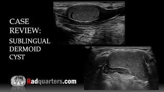 Ultrasound of Sublingual Dermoid Cyst [upl. by Deeraf217]