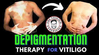 Depigmentation  A Vitiligo treatment which works and is permanent [upl. by Liesa]