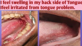 My back side of tongue bump enlargedI feel irritation from my back side of tongueTongue bump kya h [upl. by Stillmann795]