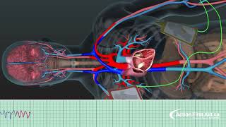 AED in Action  A 3D Look Inside the Body [upl. by Hgeilhsa]