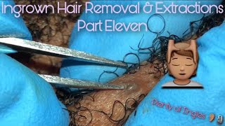 ASMR Ingrown Hair Removal amp Extractions 11 🔍 Beard amp Neck Area [upl. by Accissej]