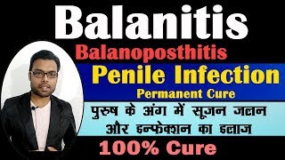 Treatment Of Balanitis  पुरुष के अंग में सूजन जलन और इन्फेक्शन का इलाज  Balanitis  Balantis [upl. by Naahsar]