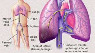 Pulmonary Embolism [upl. by Leirad491]