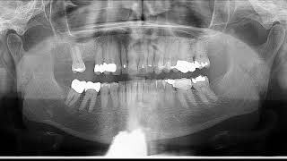 Quiz dense radiopacity on Panoramic radiograph [upl. by Bonni]