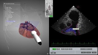 HeartWorks Pulmonary Embolism [upl. by Laram]