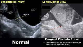 Obstetric Ultrasound Normal Pregnancy Vs Placenta Previa  LowLying Marginal Partial Complete [upl. by Nnairda155]