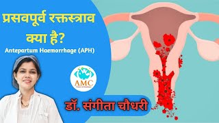 प्रसवपूर्व रक्तस्त्राव क्या है Antepartum Haemorrhage APH drsangitachaudhary [upl. by Gaither]