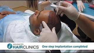 FUE Hair Transplantation StepbyStep by Dr Anastasios Vekris [upl. by Paten]