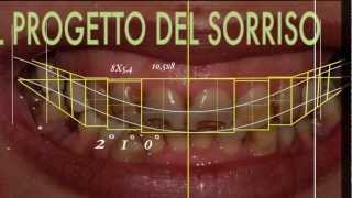 Cambiare laspetto del sorriso con faccette dentali  SMILE DESIGN [upl. by Boland361]