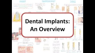 Implants An Overview Osseointegration Types of Bone One stage vs Two stage surgery [upl. by Cavit]