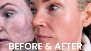 VBEAM Face LASER Treatment 2 Weeks Before and After [upl. by Ajnos]