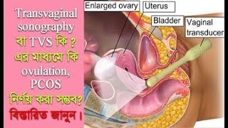 Transvaginal Sonography বা TVS কি এর মাধ্যমে কি Ovulation PCOS নিৰ্ণয় করা সম্ভবwomenscare [upl. by Llertnom608]