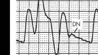 Timing and triggering of the Intraaortic Balloon Pump IABP [upl. by Annavaj]