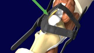 PTO Patellar Tracking Orthosis Knee Brace Directions and Application [upl. by Leeth696]