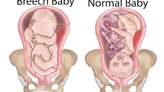 Breech Baby Treatment [upl. by Nit]