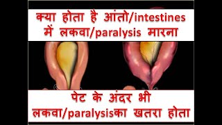 what is INTESTINAL PSEUDO  OBSTRUCTIONPARALYTIC ILEUSOGILVIE SYNDROME [upl. by Larimer]