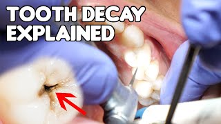 Tooth Decay Cavity Explained  Cavities vs Fillings vs Dental Caries [upl. by Ainej231]