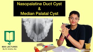 Nasopalatine Duct Cyst amp Median Palatal Cyst Lecture 15 Cysts of Orofacial Region ORAL PATHOLOGY [upl. by Nolos]