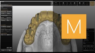 Occlusally screwed bridges module of ZirkonzahnModellier  ZirkonzahnSoftware [upl. by Acsisnarf522]