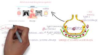 ARDS acute respiratory distress syndromeشرح [upl. by Gladstone610]