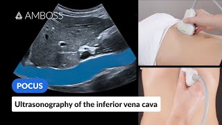 Point of Care Ultrasound of the Inferior Vena Cava IVC  AMBOSS Video [upl. by Atilemrac]