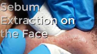 Sebum Extraction on the Face [upl. by Batory128]