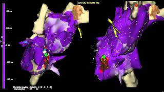 AV node reentry tachycardia atrial activation with 3D mapping [upl. by Silloh]