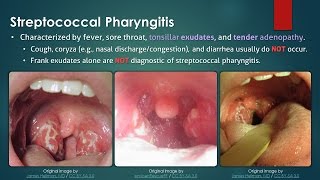 Streptococcal Pharyngitis [upl. by Nalor]