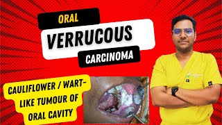 Dr Rudra Mohan  Oral Verrucous CarcinomaCauliflower WartLike Tumour of the Oral Cavity  OVC [upl. by Assenal262]