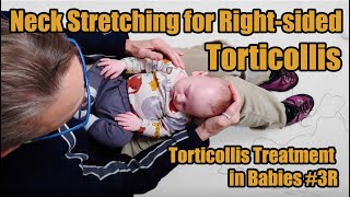 3R Neck Stretching for Rightsided Torticollis Torticollis Treatment in Babies [upl. by Deys]