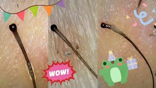 Satisfying Hair Follicle Plucks Big Roots Hair Extraction Under Microscope [upl. by Adolph490]