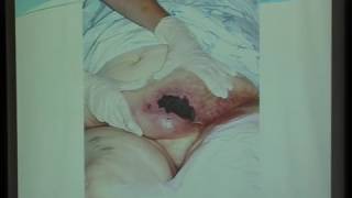 UNC VIDEOS calcified Uremic Arteriolopathy Calciphylaxis Dr Mohamed Sobh [upl. by Ahsienal]