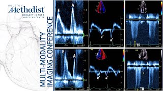 Heart Failure II How to Evaluate Diastolic Function Nagueh MD ChamsiPasha MD January 11 2022 [upl. by Mairb662]