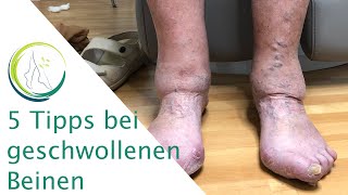 5 Tipps bei Geschwollenen Beinen [upl. by Unni34]