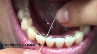 Como Passar Fio Dental no Dente com Aparelho  Orlando Tanaka [upl. by Shatzer162]