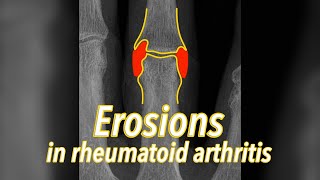 Erosions on Xrays in rheumatoid arthritis  explained in 30 seconds [upl. by Kcira695]