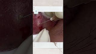 Big Cystic Acne Blackheads Extraction Blackheads amp Milia Whiteheads Removal Pimple Popping Shorts [upl. by Irep]