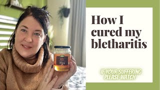 How I cured my BLEPHARITIS  chronic eye condition [upl. by Vedetta278]