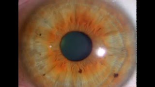 Iridology Lesson 2 Sulfur amp Candida How to Spot amp Detox It Out [upl. by Palermo]