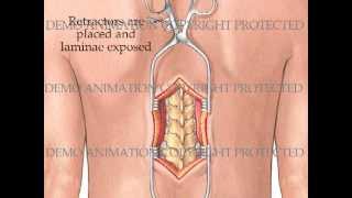 Transpedicular Thoracic Corpectomy [upl. by Llenyt]