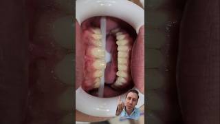 🔴ANTES E DEPOIS FACETAS CASO Extremo🙀diastemas conóides e ausência de laterais dentist [upl. by Sarad]