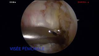 Ligamentoplastie du Ligament Croisé Antérieur LCA  Dr SIMIAN Périgueux [upl. by Sixela]