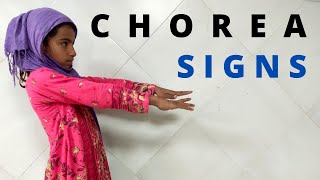 Understanding Chorea Common Signs in Children Chorea Signs [upl. by Liebermann]